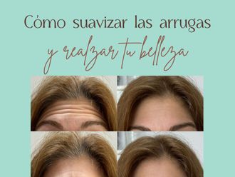 Eliminación arrugas antes y después - 875696