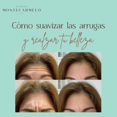 Eliminación de arrugas