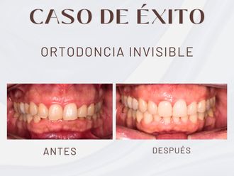 Ortodoncia invisible antes y después - 875697