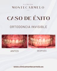 Ortodoncia Invisible