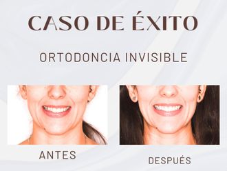 Ortodoncia invisible antes y después - 875698