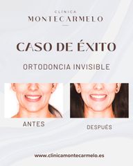 Ortodoncia Invisible