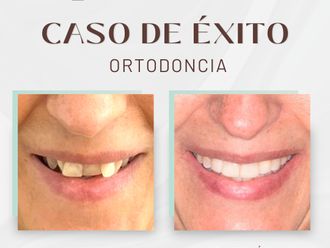 Ortodoncia antes y después - 875699