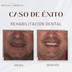 Rehabilitación dental