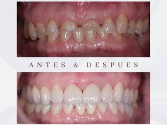 Ortodoncia antes y después - 875701