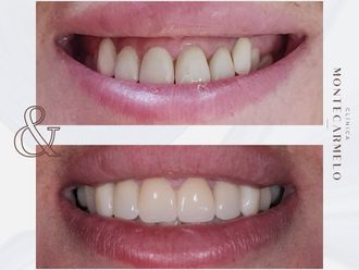 Carillas dentales antes y después - 875702