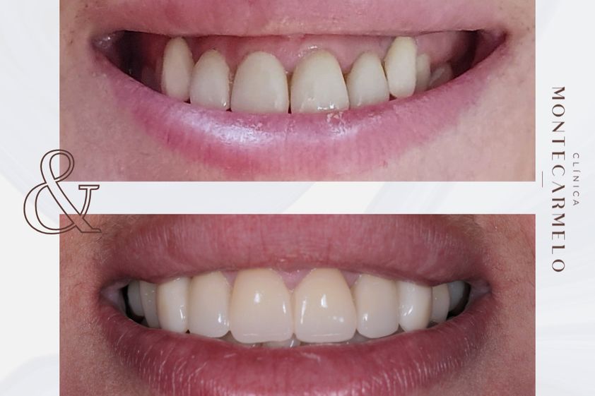 Carillas dentales antes y después - 875702