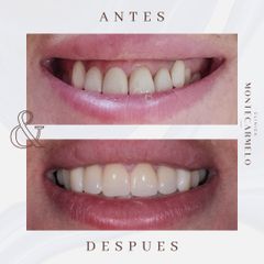 Carillas dentales