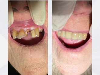 Implantes dentales antes y después - 875703