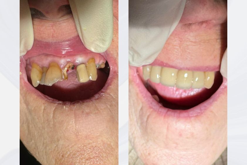 Implantes dentales antes y después - 875703