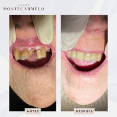 Implantes dentales