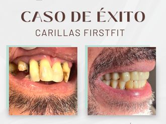 Carillas dentales antes y después - 875704