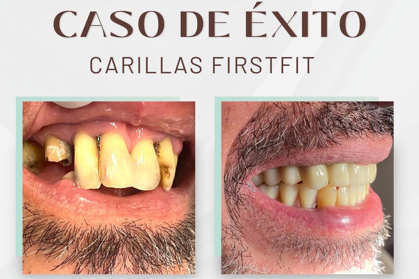 Carillas dentales antes y después - 875704
