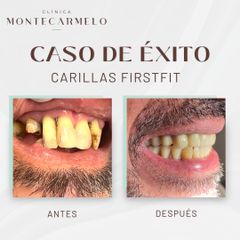 Carillas dentales