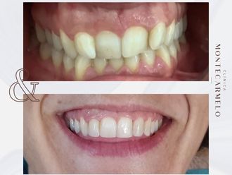 Carillas dentales antes y después - 875705