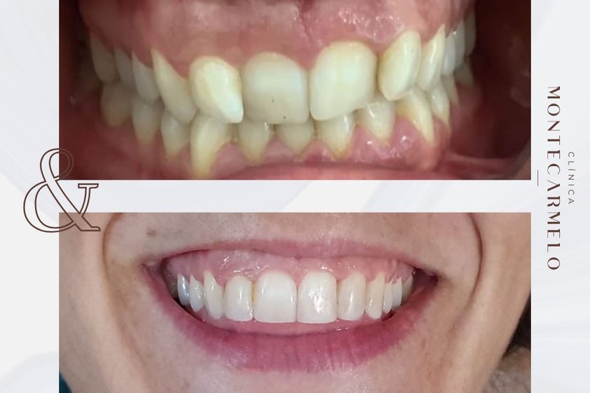 Carillas dentales antes y después - 875705