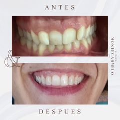 Carillas dentales