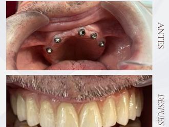 Implantes dentales antes y después - 875706