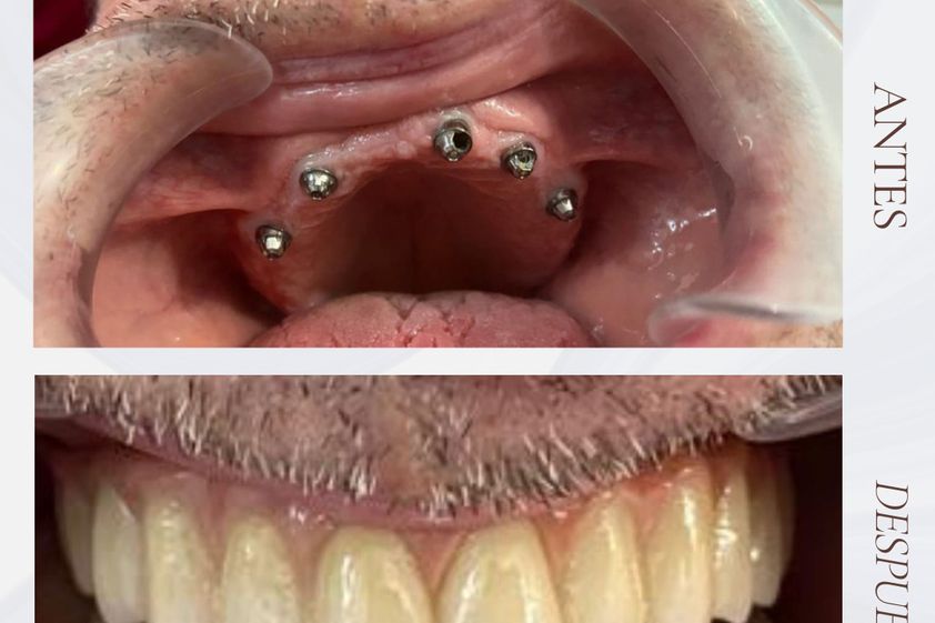 Implantes dentales antes y después - 875706