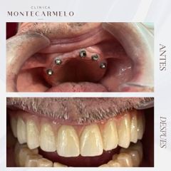Implantes dentales