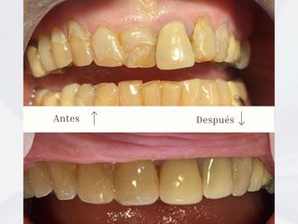 Carillas dentales antes y después - 875707