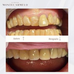 Carillas dentales