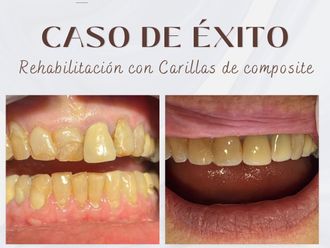 Carillas dentales antes y después - 875708