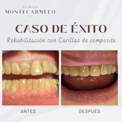 Carillas dentales