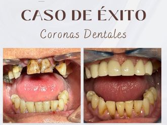 Carillas dentales antes y después - 875709