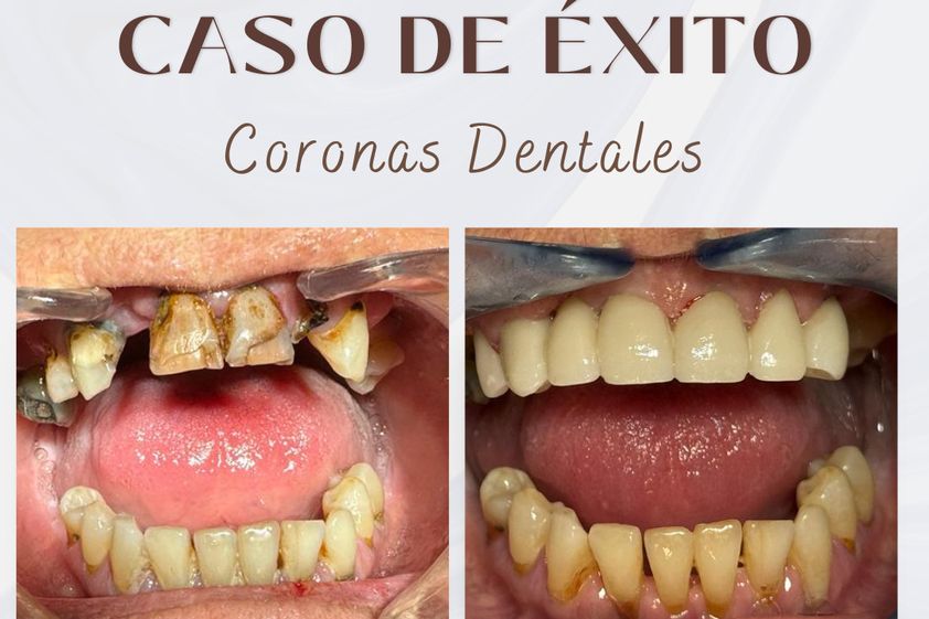 Carillas dentales antes y después - 875709