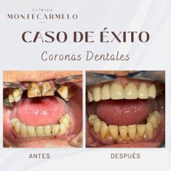 Carillas dentales