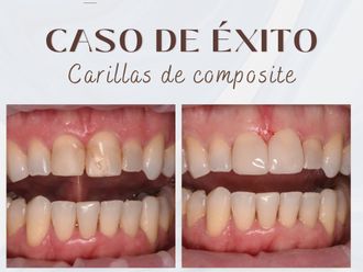 Carillas dentales antes y después - 875710
