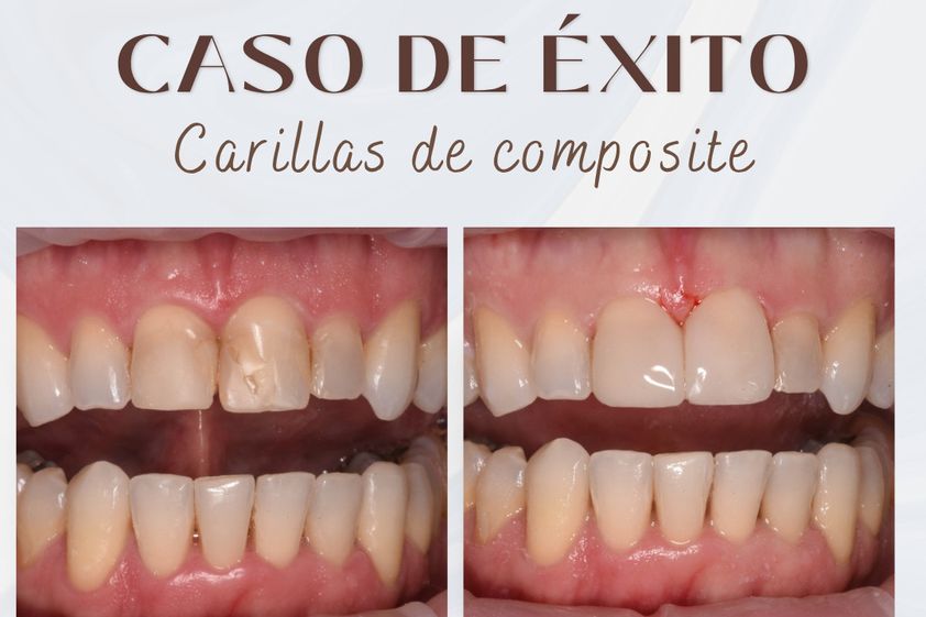 Carillas dentales antes y después - 875710