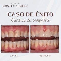 Dental - Carillas