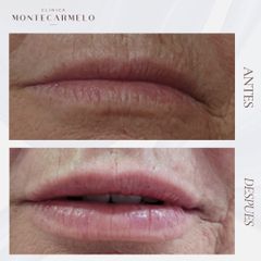 Aumento de labios