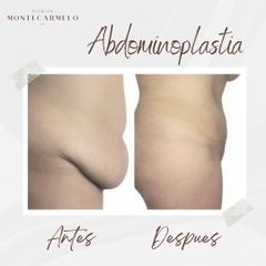 Clínica Montecarmelo - Abdominoplastia