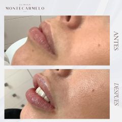 Clínica Montecarmelo - Aumento de labios
