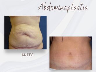 Abdominoplastia antes y después - 875780