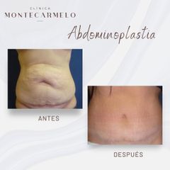 Clínica Montecarmelo - Abdominoplastia