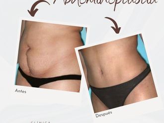 Abdominoplastia antes y después - 875781