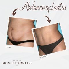 Clínica Montecarmelo - Abdominoplastia