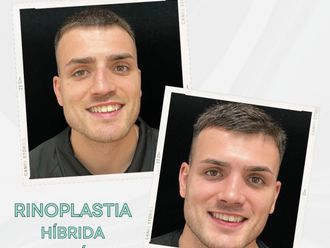 Rinoplastia antes y después - 875820