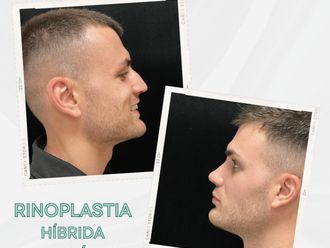 Rinoplastia antes y después - 875822