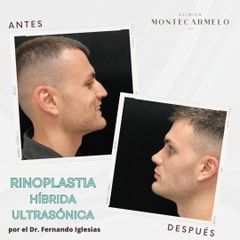 Clínica Montecarmelo - Rinoplastia