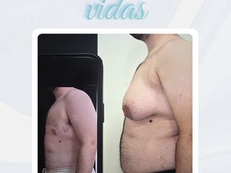 Ginecomastia antes y después - 875823