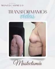 Clínica Montecarmelo - Mastectomía