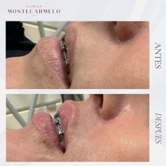Clínica Montecarmelo - Aumento de labios
