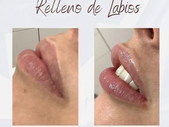 Aumento labios antes y después - 875826