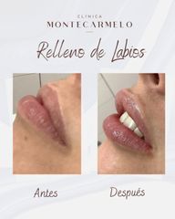 Clínica Montecarmelo - Aumento de labios