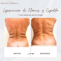Clínica Montecarmelo - Liposucción